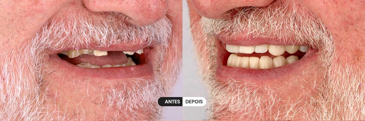 implantes dentários clinica dentária Porto