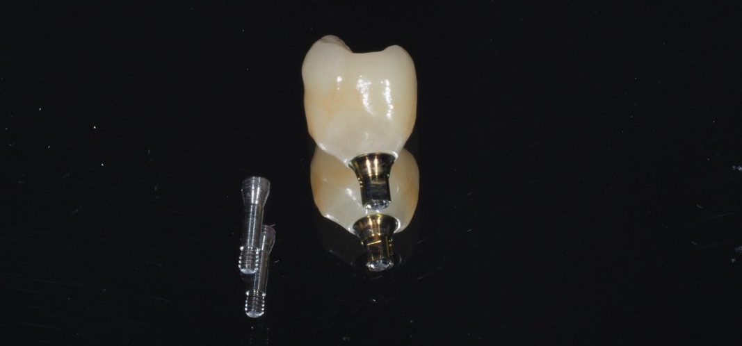 implantes dentários Porto