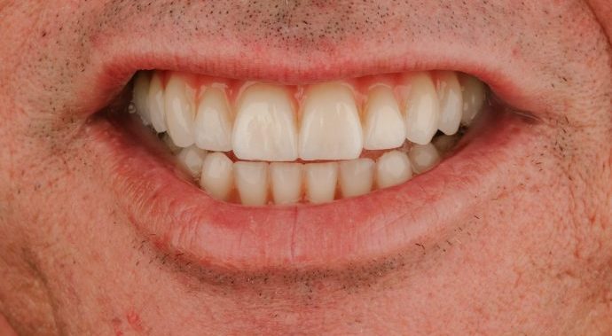 reabilitação oral sobre implantes dentarios clinica dentaria porto