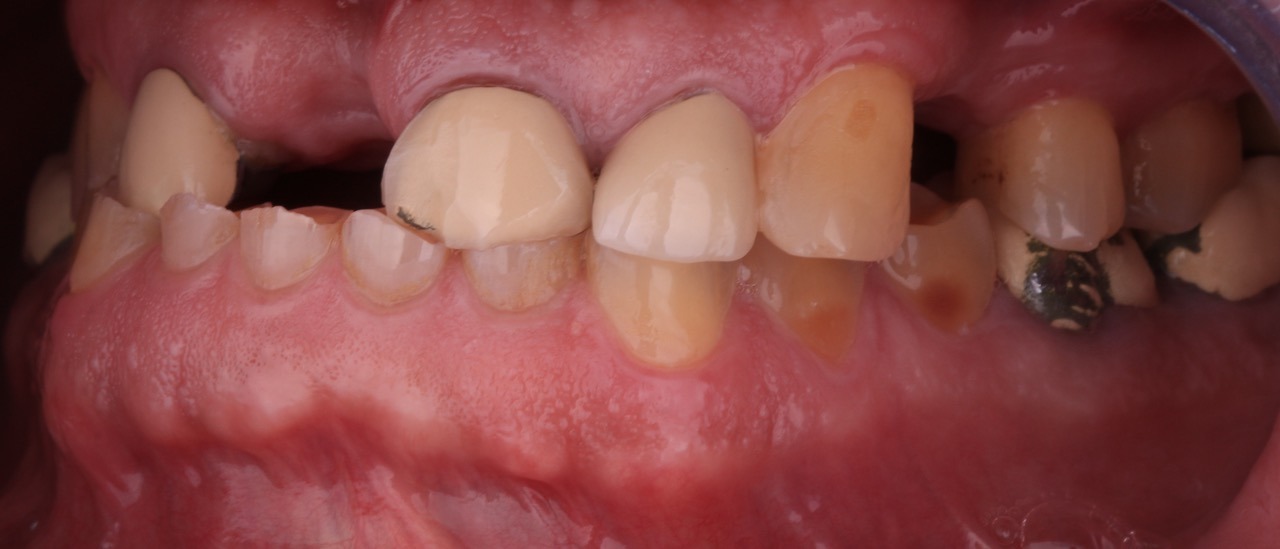 caso de desgaste dentário