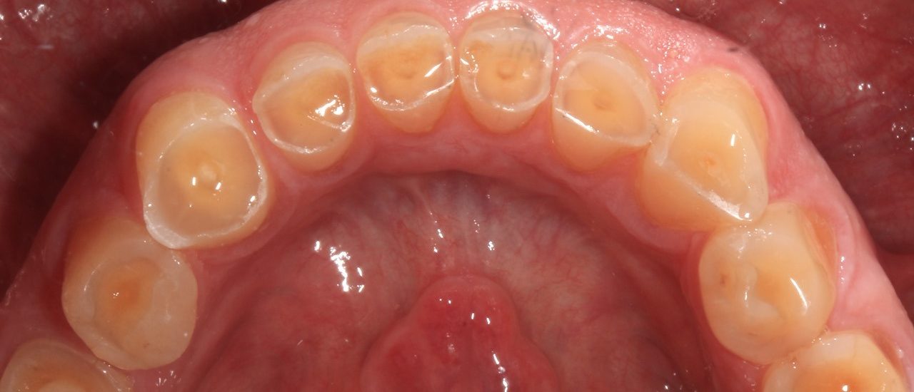 exemplo de desgaste dentário