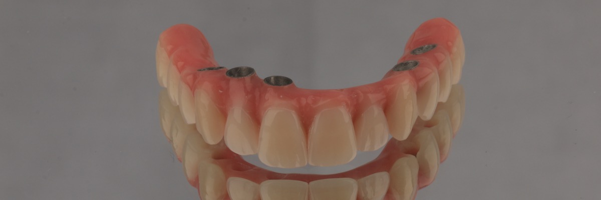 lesões apicais implantes dentários