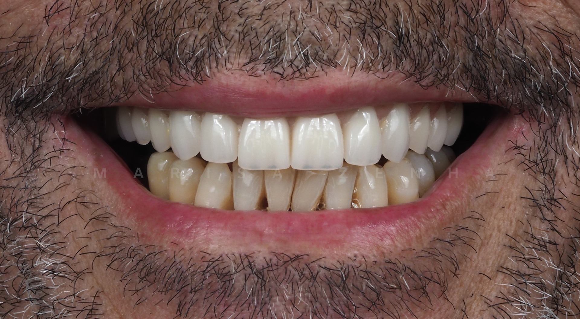 Caso 10 - Implantes Dentários