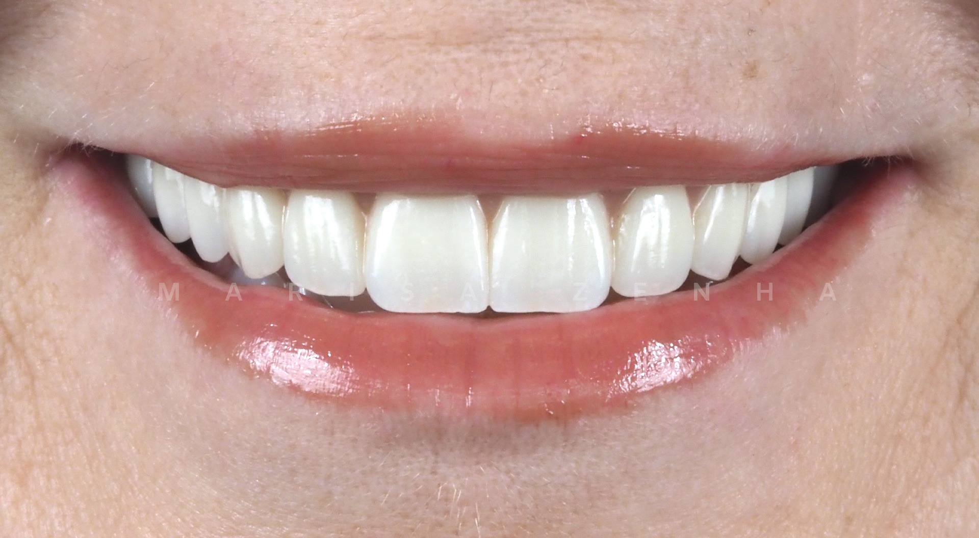 Caso 12 - Implantes Dentários