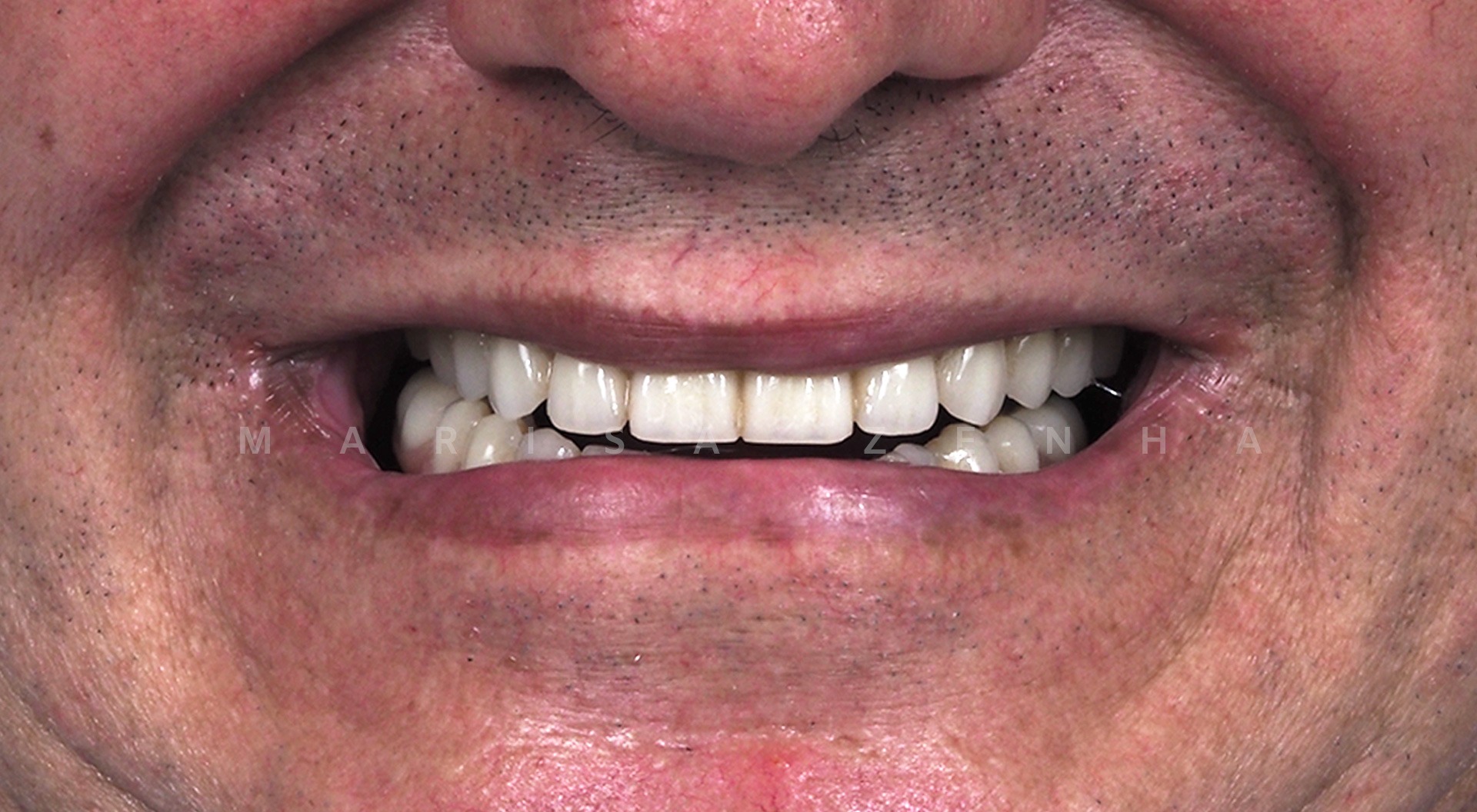 Caso 13 - Implantes Dentários