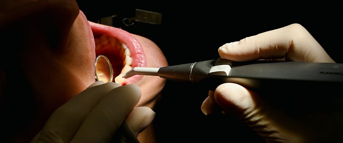 indicações facetas dentárias